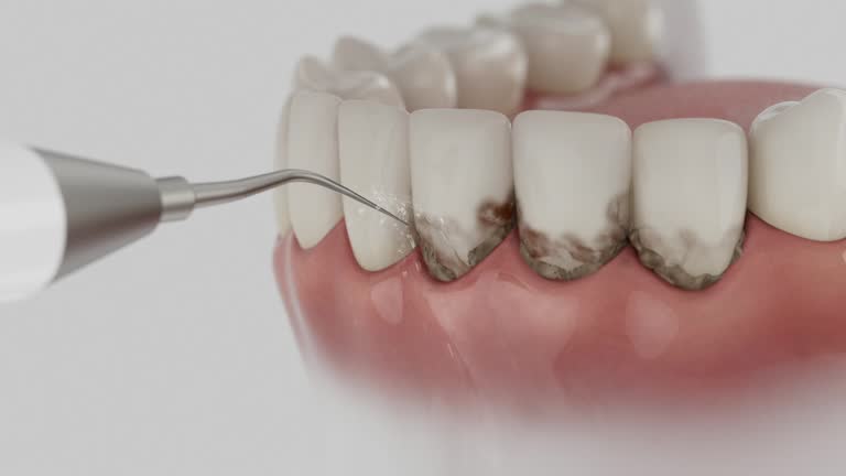 Reliable Wisdom Tooth Removal contractor in Muskingum County County, OH by Dentist Open Now